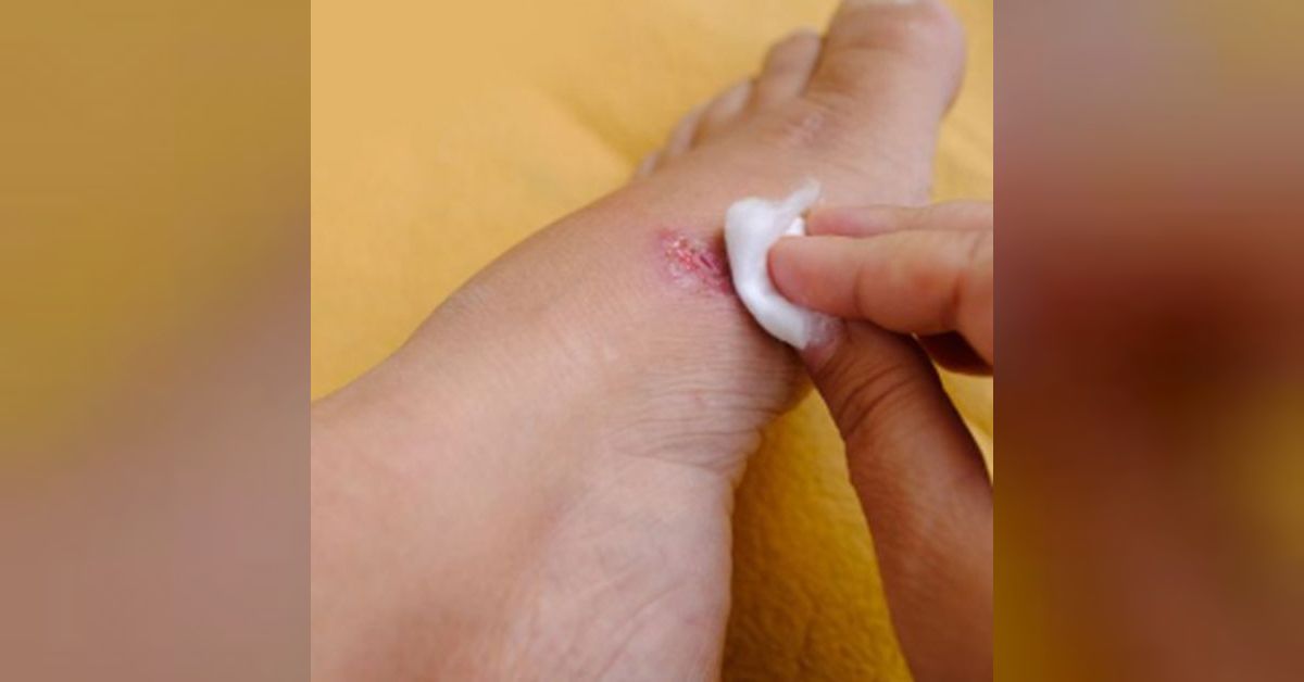 How to Effectively Help Wounds, Cuts and Scratches Heal Faster ...