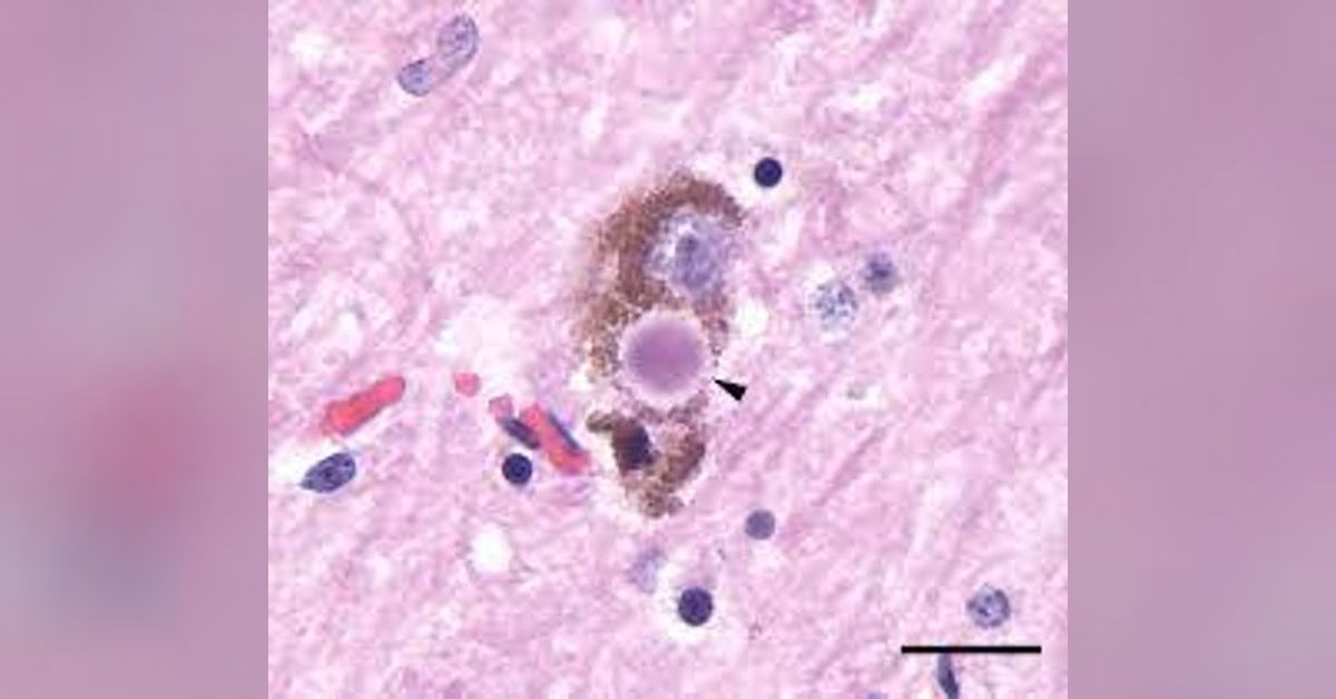Avsnitt 57 Lewy body sjukdom Demensdialogen Angvik & Björk