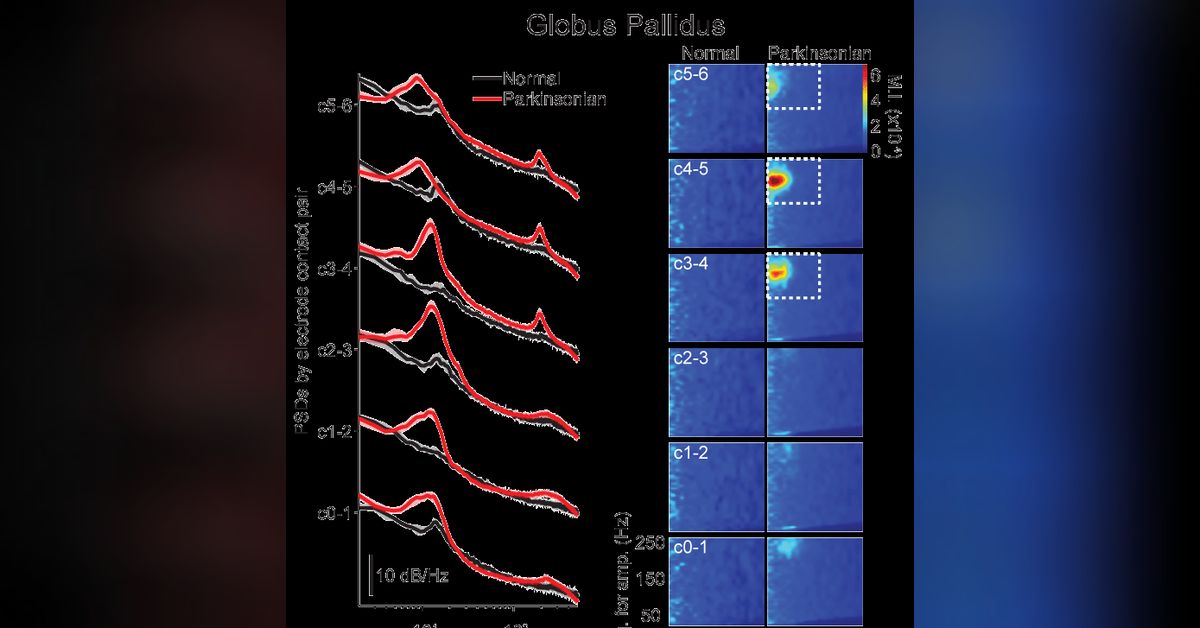 Neural oscillations and phase-amplitude coupling in Parkinson's disease ...